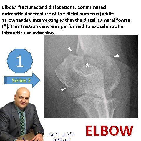 Elbow, fractures and dislocations. Comminuted extraarticular fracture of the distal humerus (white arrowheads), intersecting