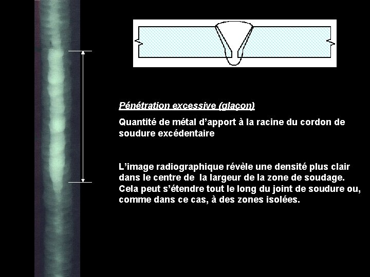 Pénétration excessive (glaçon) Quantité de métal d’apport à la racine du cordon de soudure