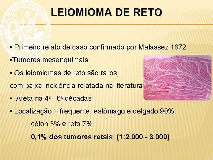 LEIOMIOMA DE RETO • Primeiro relato de caso confirmado por Malassez 1872 • Tumores