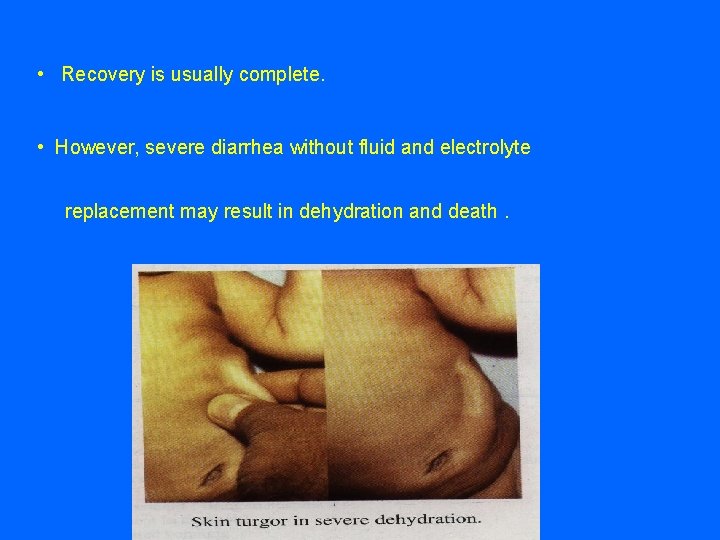  • Recovery is usually complete. • However, severe diarrhea without fluid and electrolyte
