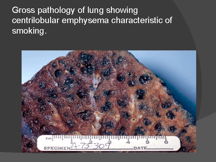 Gross pathology of lung showing centrilobular emphysema characteristic of smoking. 