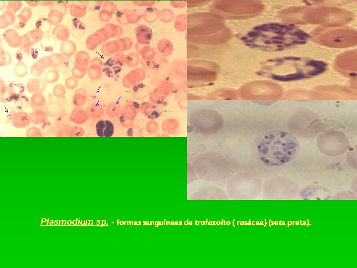 Plasmodium sp. - formas sanguíneas de trofozoíto ( rosácea) (seta preta). 