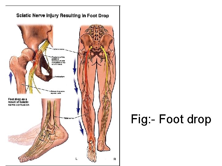 Fig: - Foot drop 