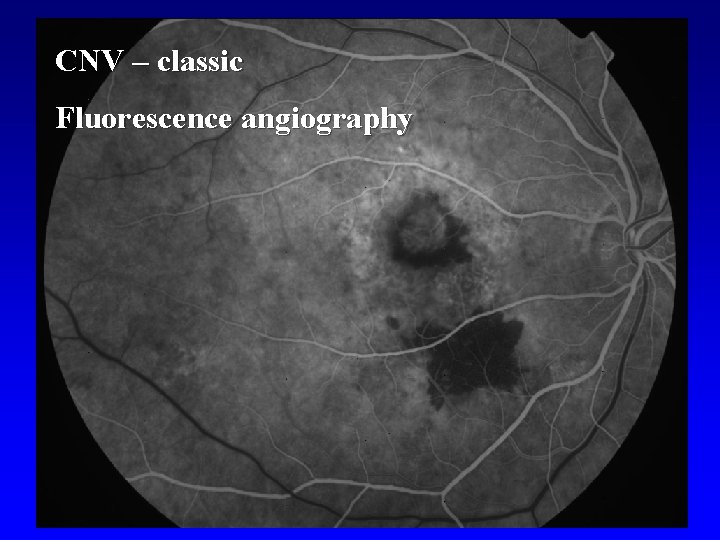 CNV – classic Fluorescence angiography 