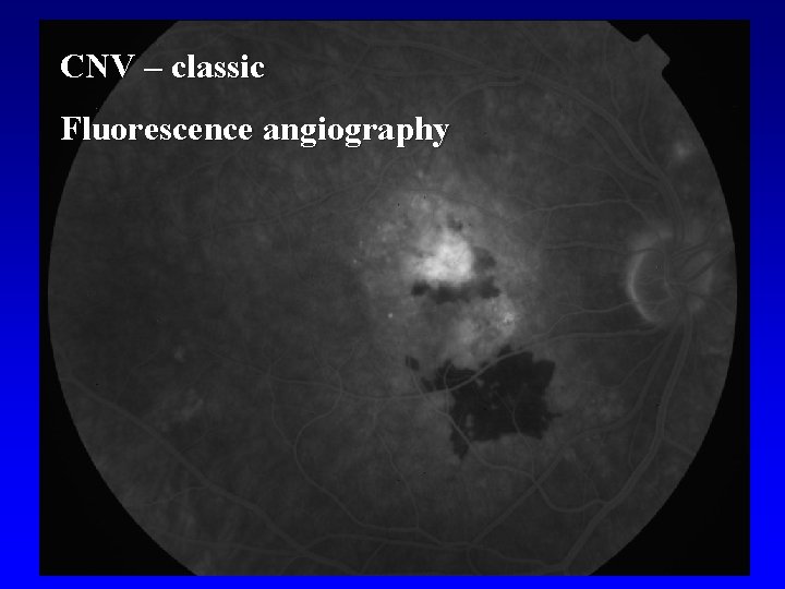 CNV – classic Fluorescence angiography 