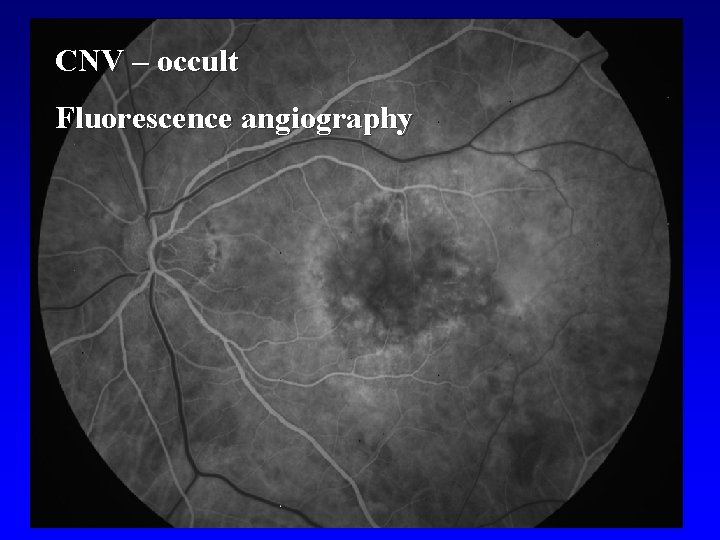 CNV – occult Fluorescence angiography 