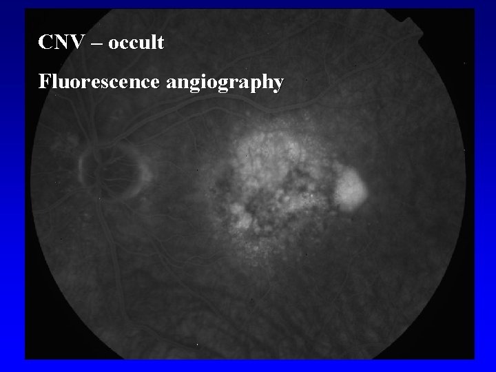 CNV – occult Fluorescence angiography 