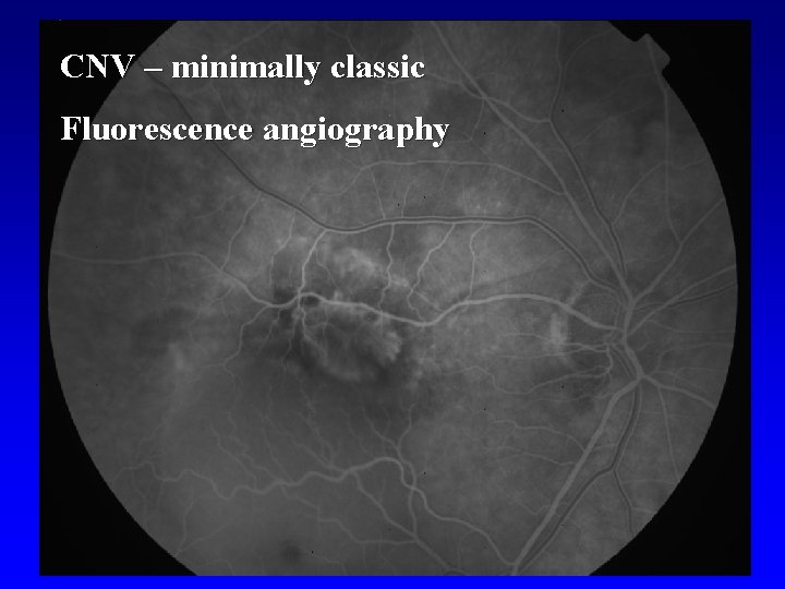 CNV – minimally classic Fluorescence angiography 