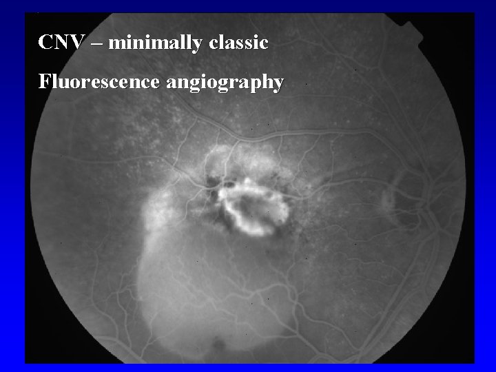 CNV – minimally classic Fluorescence angiography 