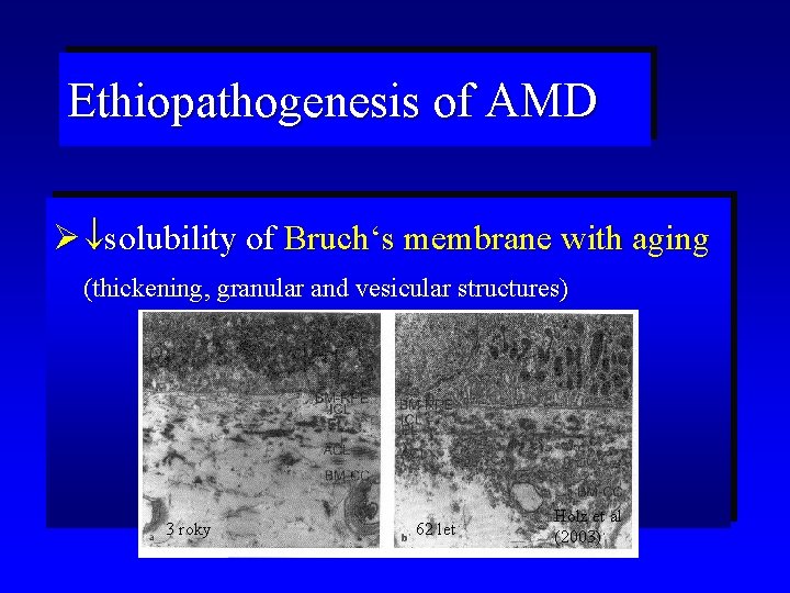 Ethiopathogenesis of AMD Ø solubility of Bruch‘s membrane with aging (thickening, granular and vesicular