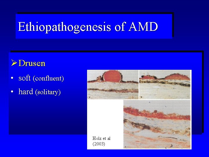 Ethiopathogenesis of AMD Ø Drusen • soft (confluent) • hard (solitary) Holz et al