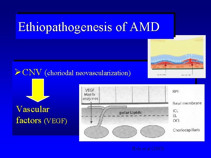 Ethiopathogenesis of AMD Ø CNV (choriodal neovascularization) Vascular factors (VEGF) Holz et al (2003)