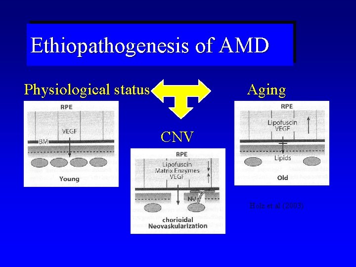 Ethiopathogenesis of AMD Physiological status Aging CNV Holz et al (2003) 