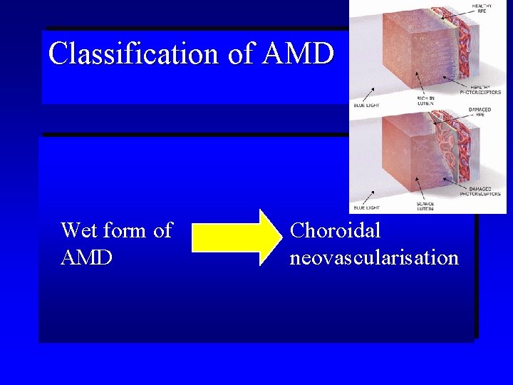 Classification of AMD Wet form of AMD Choroidal neovascularisation 