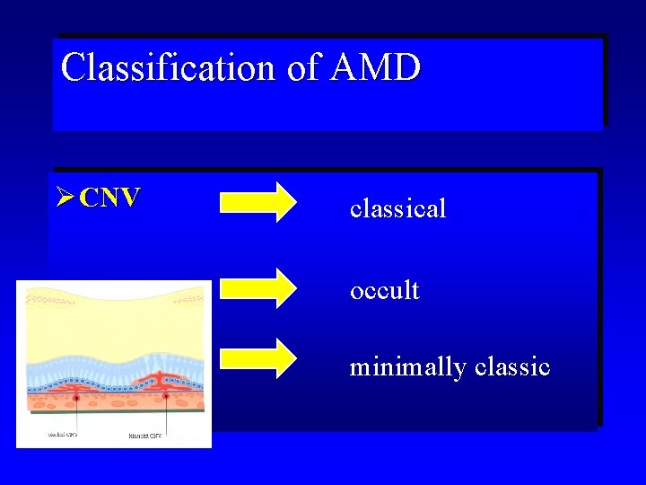 Classification of AMD Ø CNV classical occult minimally classic 