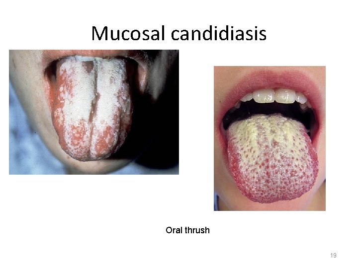 Mucosal candidiasis Oral thrush 19 