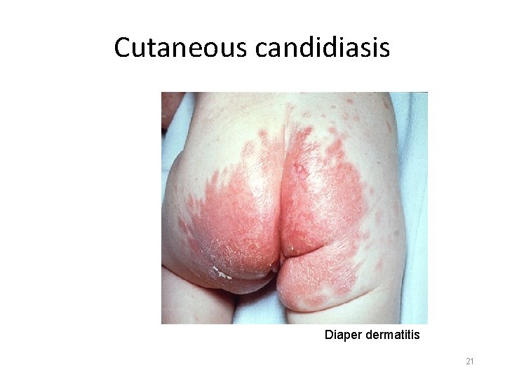 Cutaneous candidiasis Diaper dermatitis 21 