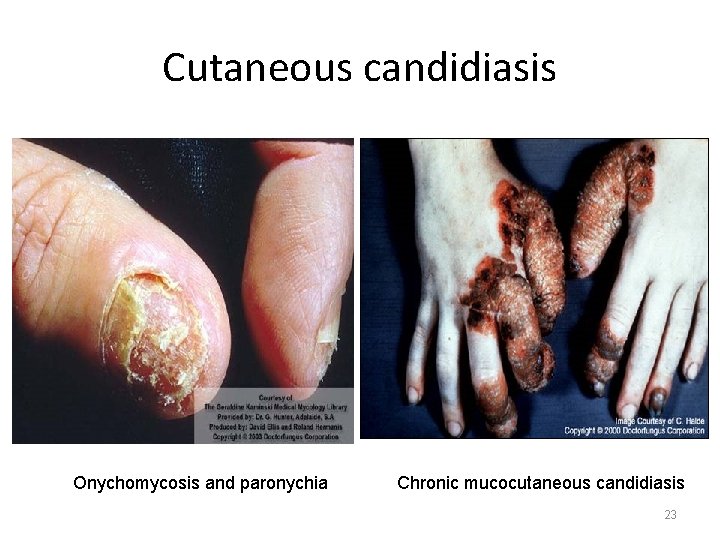 Cutaneous candidiasis Onychomycosis and paronychia Chronic mucocutaneous candidiasis 23 