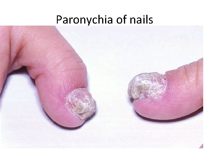Paronychia of nails 