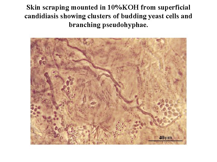 Skin scraping mounted in 10%KOH from superficial candidiasis showing clusters of budding yeast cells