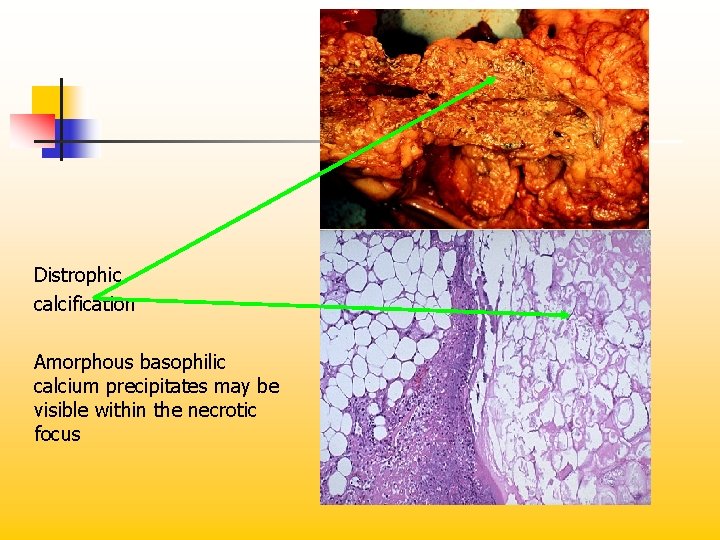 Distrophic calcification Amorphous basophilic calcium precipitates may be visible within the necrotic focus 