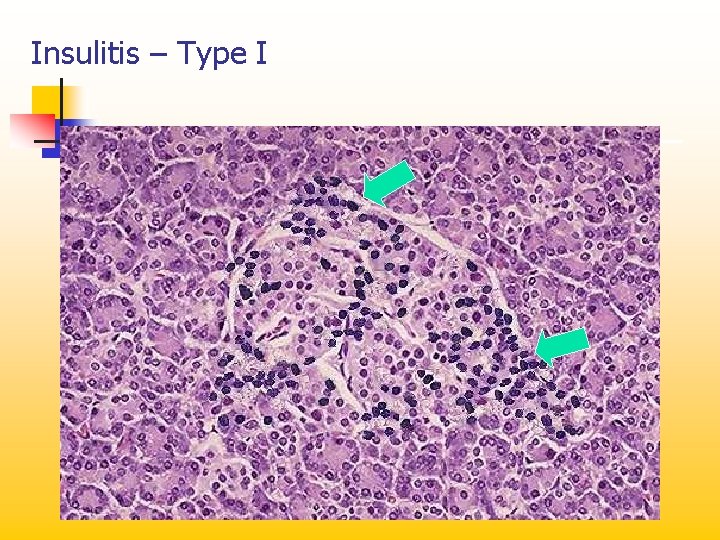Insulitis – Type I 