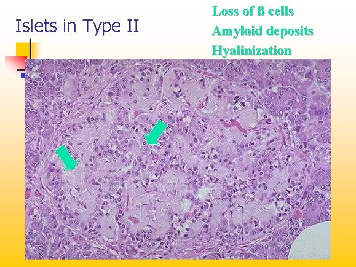 Islets in Type II Loss of ß cells Amyloid deposits Hyalinization 