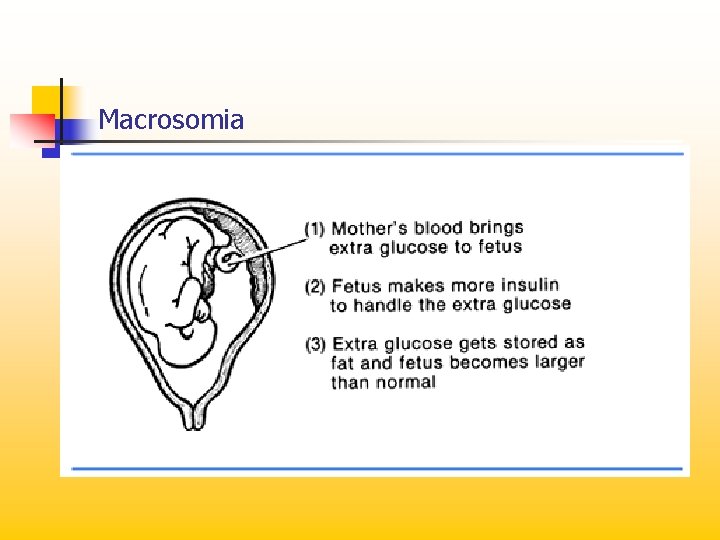 Macrosomia 
