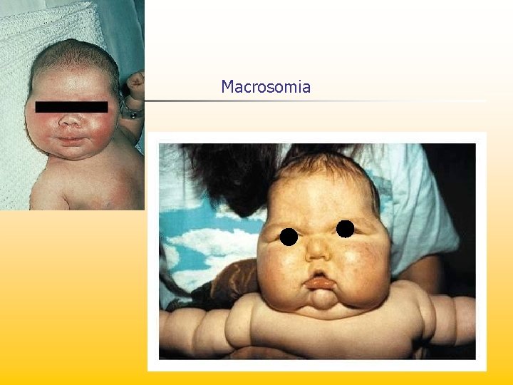 Macrosomia 
