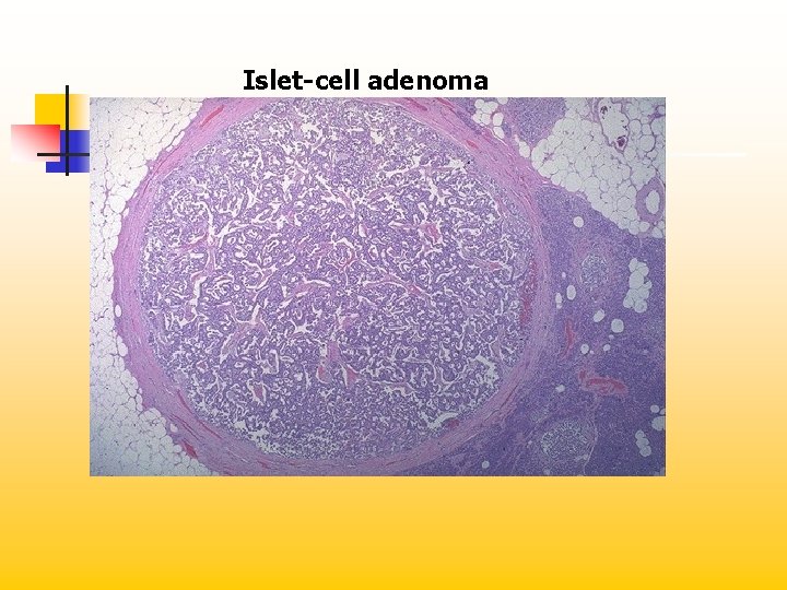 Islet-cell adenoma 