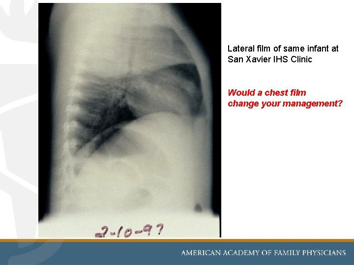 Lateral film of same infant at San Xavier IHS Clinic Would a chest film