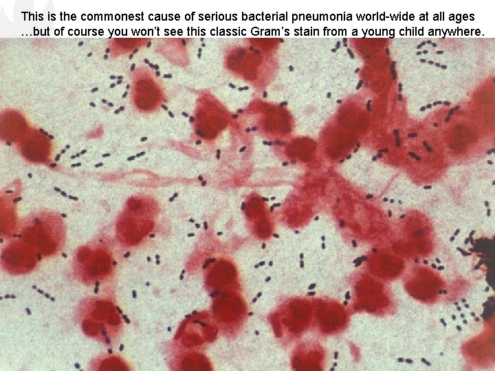 This is the commonest cause of serious bacterial pneumonia world-wide at all ages …but