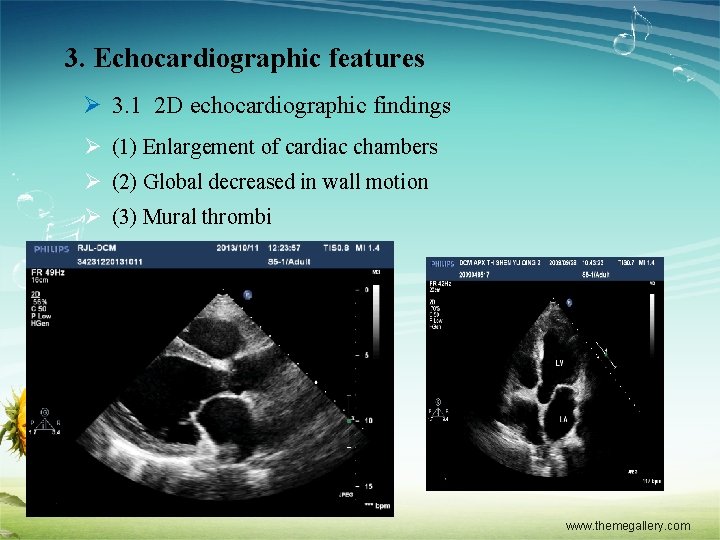 3. Echocardiographic features Ø 3. 1 2 D echocardiographic findings Ø (1) Enlargement of