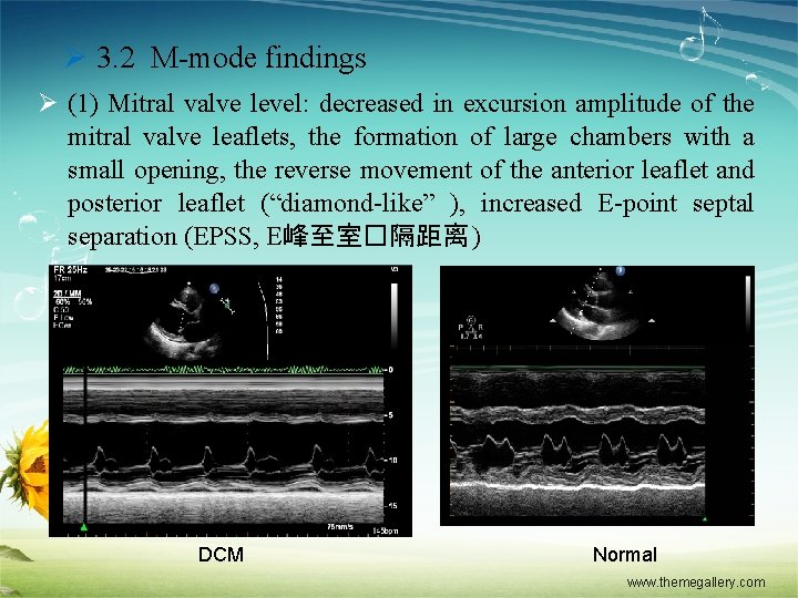 Ø 3. 2 M-mode findings Ø (1) Mitral valve level: decreased in excursion amplitude