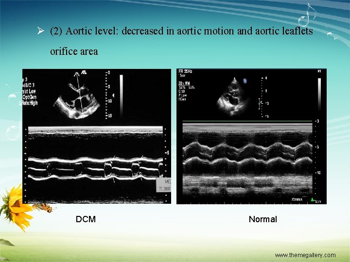 Ø (2) Aortic level: decreased in aortic motion and aortic leaflets orifice area DCM
