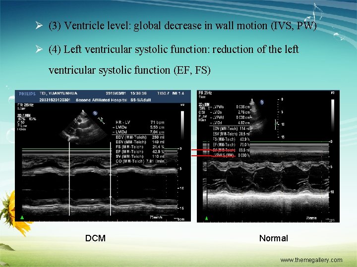 Ø (3) Ventricle level: global decrease in wall motion (IVS, PW) Ø (4) Left