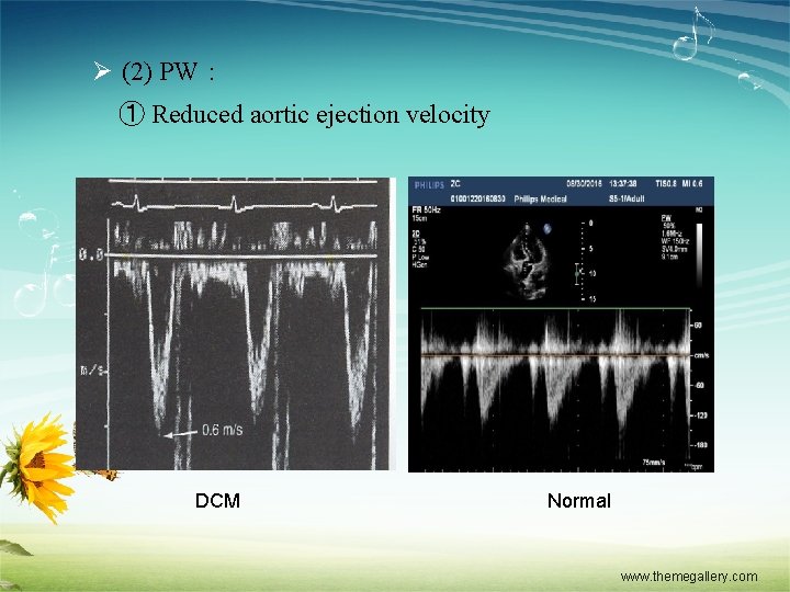Ø (2) PW： ① Reduced aortic ejection velocity DCM Normal www. themegallery. com 