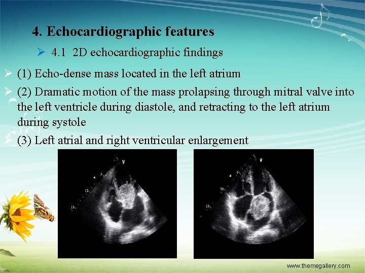 4. Echocardiographic features Ø 4. 1 2 D echocardiographic findings Ø (1) Echo-dense mass