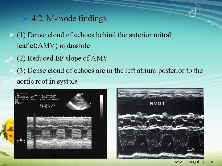 Ø 4. 2. M-mode findings Ø (1) Dense cloud of echoes behind the anterior