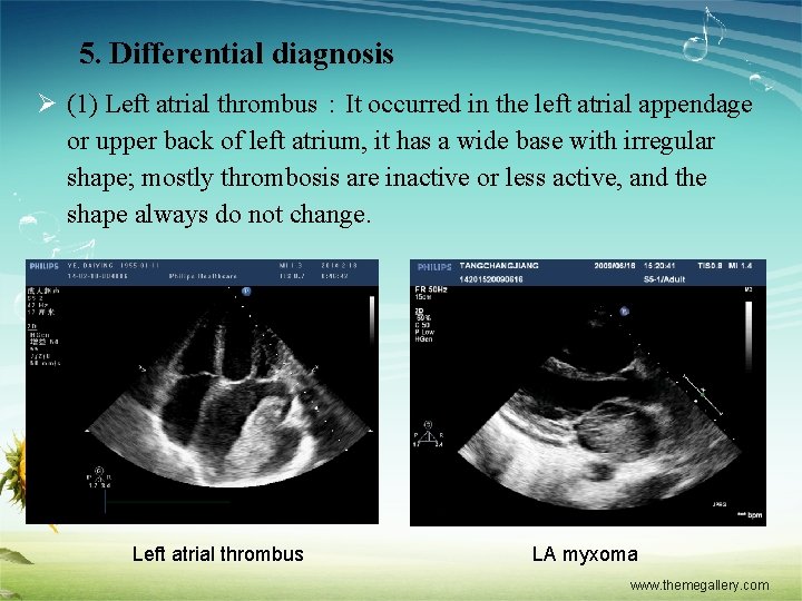 5. Differential diagnosis Ø (1) Left atrial thrombus：It occurred in the left atrial appendage
