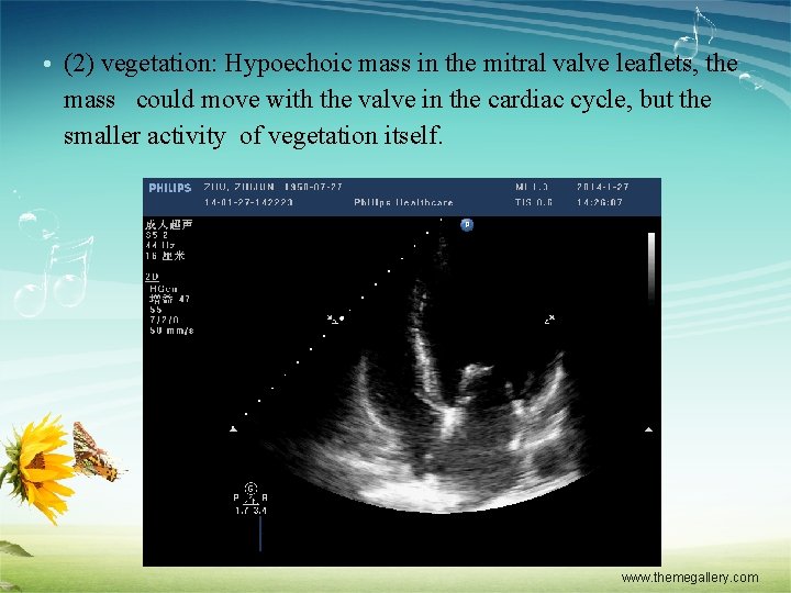  • (2) vegetation: Hypoechoic mass in the mitral valve leaflets, the mass could
