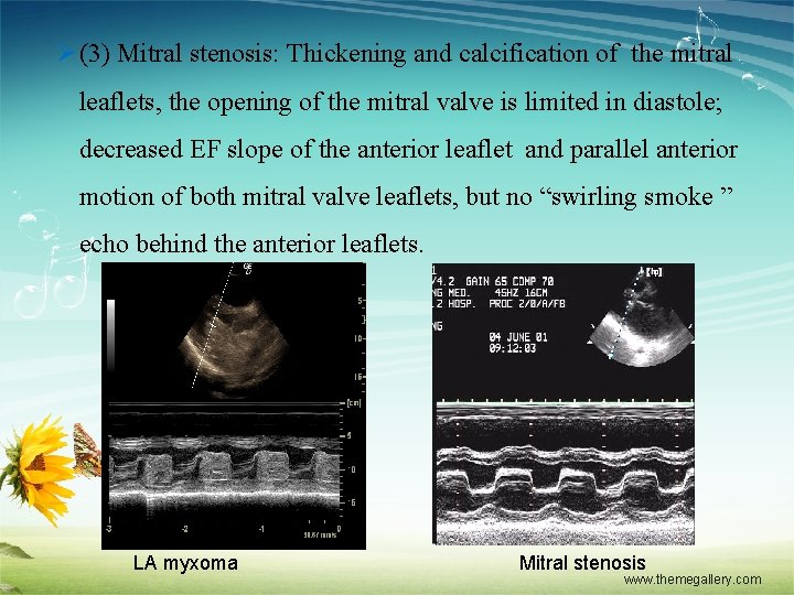 Ø(3) Mitral stenosis: Thickening and calcification of the mitral leaflets, the opening of the