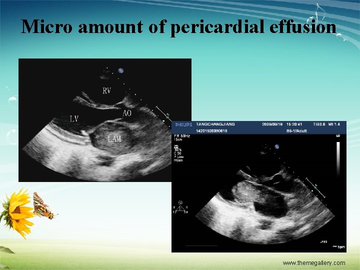 Micro amount of pericardial effusion www. themegallery. com 