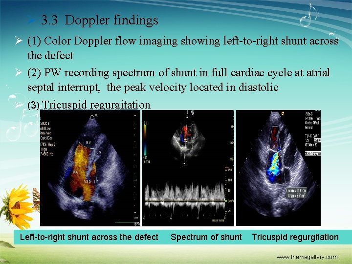 Ø 3. 3 Doppler findings Ø (1) Color Doppler flow imaging showing left-to-right shunt