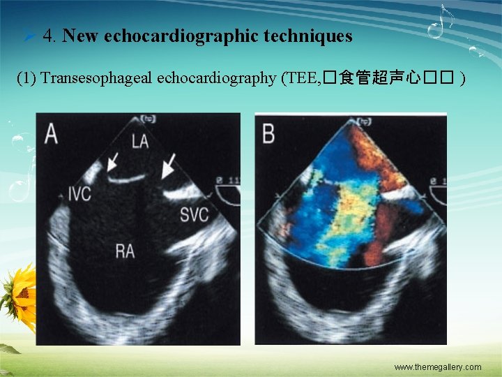 Ø 4. New echocardiographic techniques (1) Transesophageal echocardiography (TEE, �食管超声心�� ) www. themegallery. com