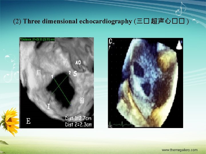 (2) Three dimensional echocardiography (三� 超声心�� ) www. themegallery. com 