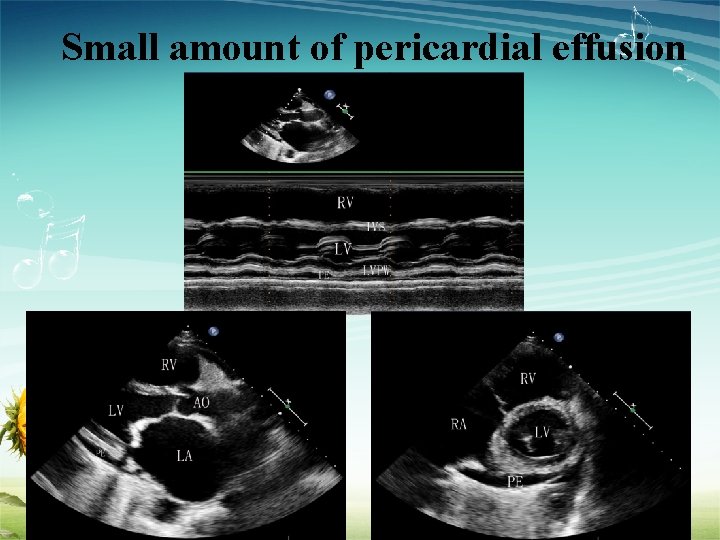 Small amount of pericardial effusion www. themegallery. com 