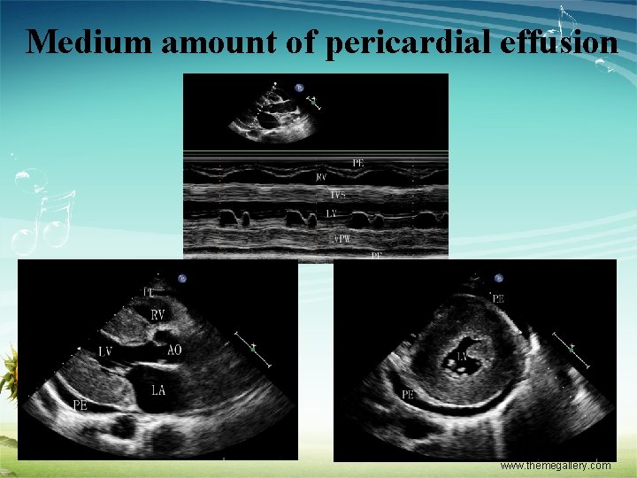 Medium amount of pericardial effusion www. themegallery. com 
