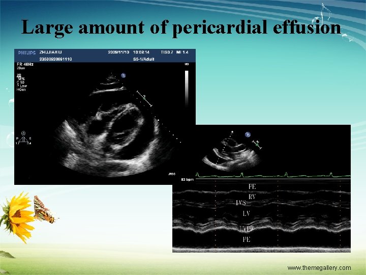 Large amount of pericardial effusion www. themegallery. com 
