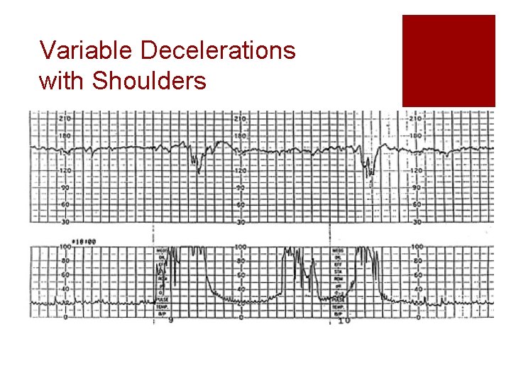 Variable Decelerations with Shoulders 